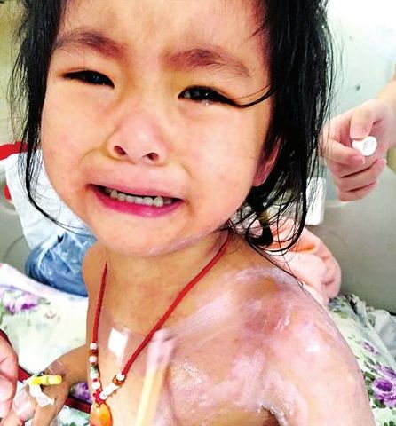 3歲的蘭蘭，全身紅疹，因疼癢難忍而大哭
