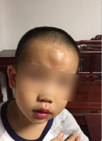 男童被送快遞的電動(dòng)車撞飛一米多，額頭腫起乒乓球大的包